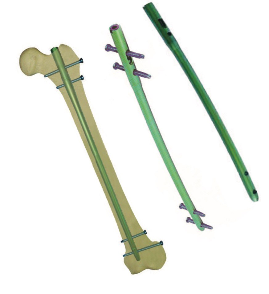 UFN універсальний стегновий стрижень інтрамедулярної фіксації